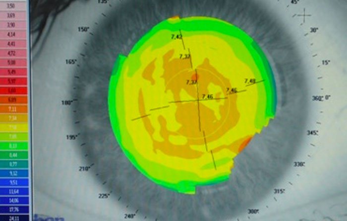 Fuhlendorf Optik Keterograph