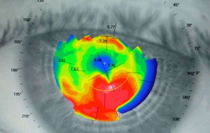 Fuhlendorf Optik Keterograph